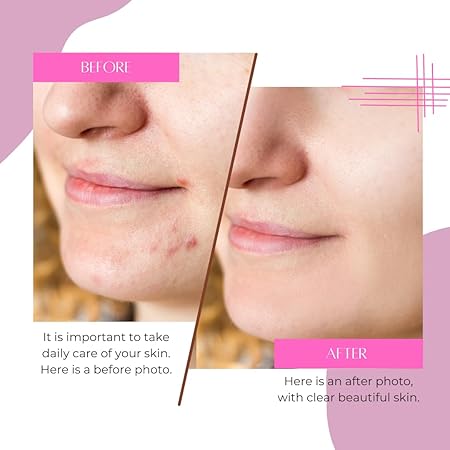 Nimtug Acne patch